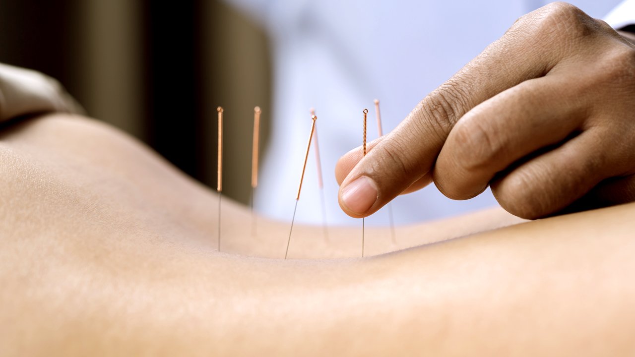 Akupunktur på ryggen