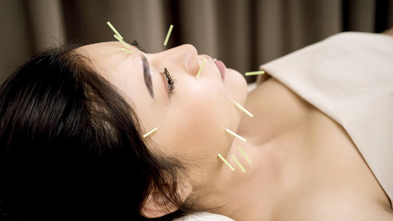 Kvinde får akupunktur i ansigtet