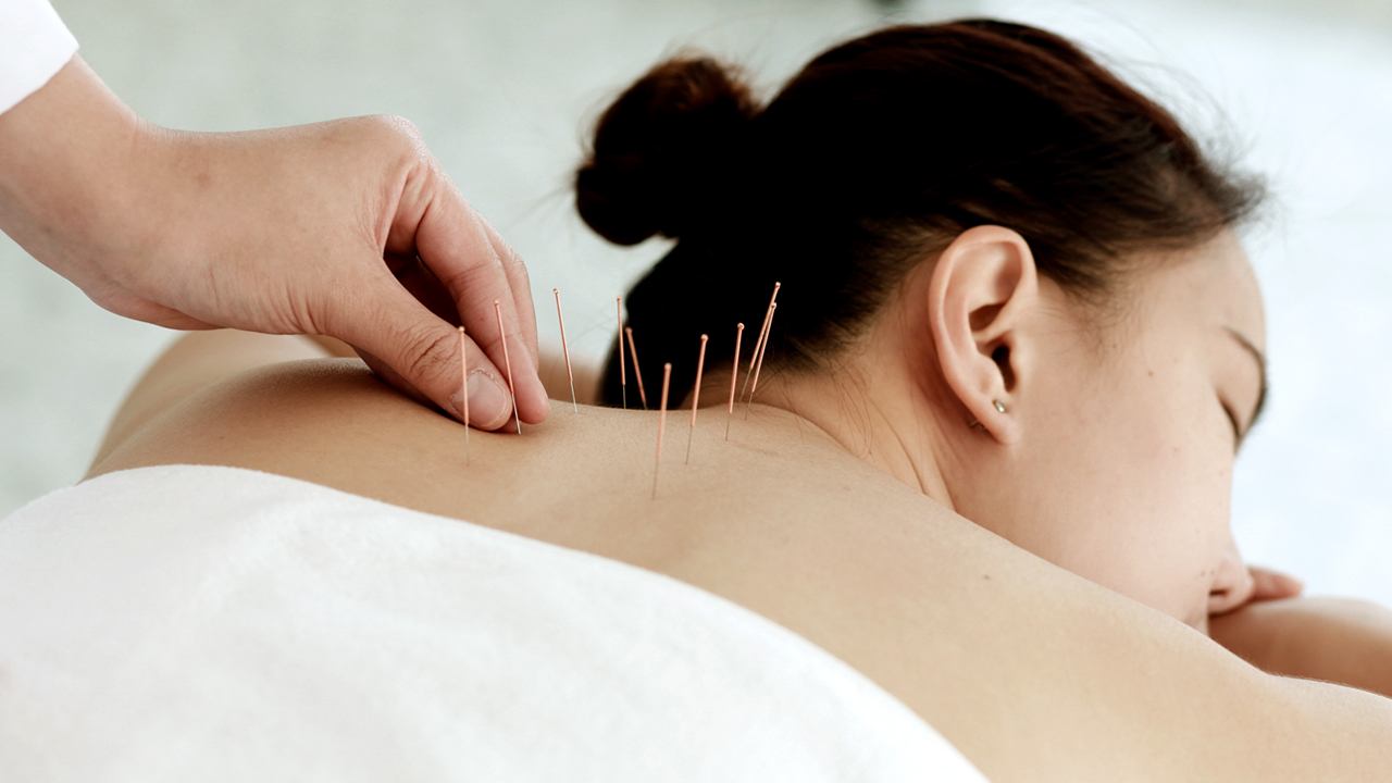 Kvinde får akupunktur på ryggen