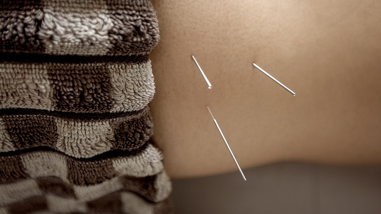 Akupunktur behandler fertilitetsproblemer