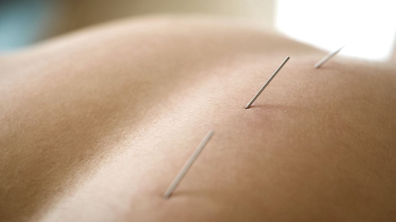 Akupunktur behandling mod barnløshed